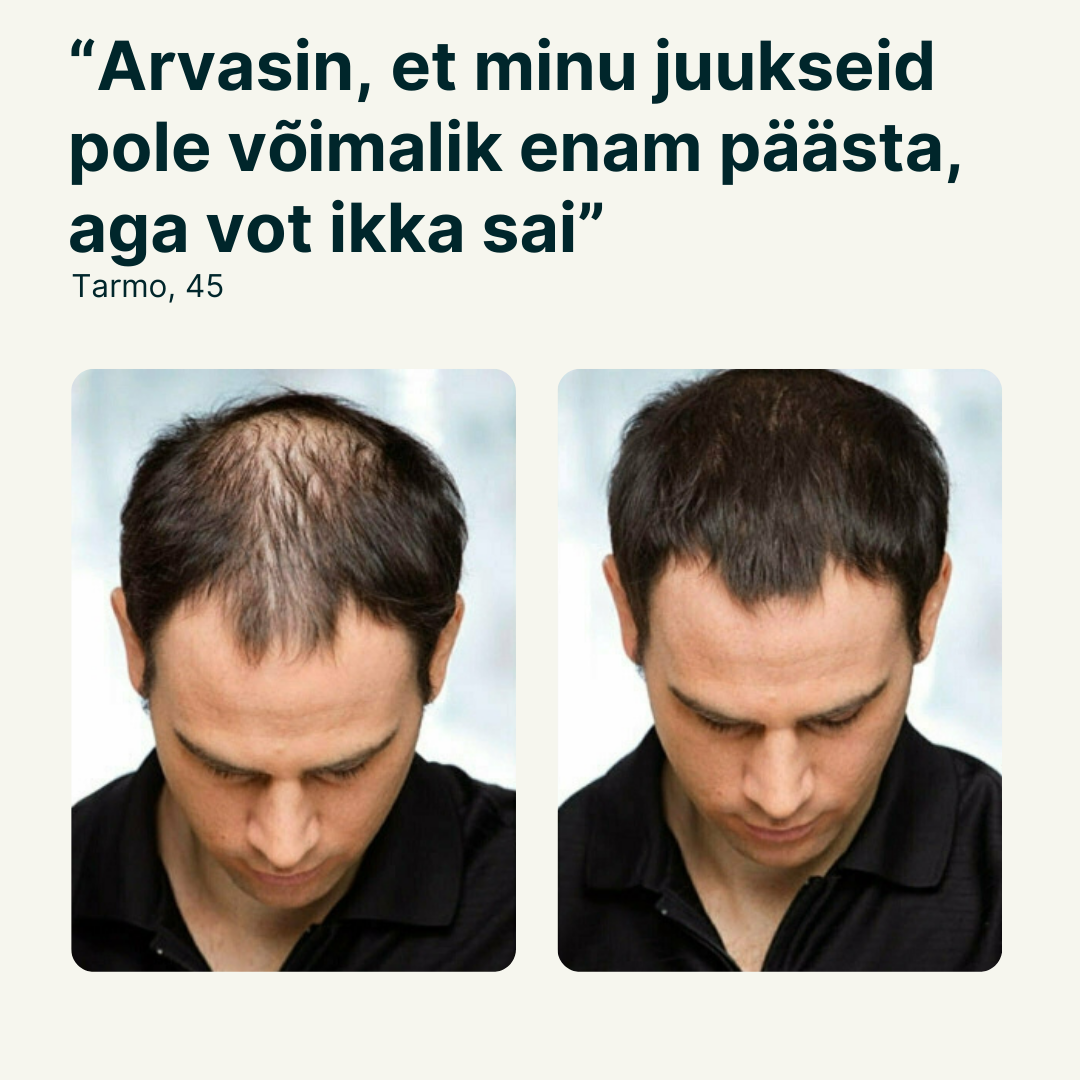 Juuksekasvu seerum meestele